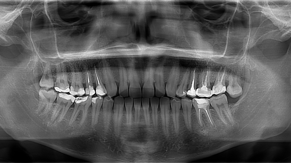 Radiografía Panorámica Dental (ortopantomografía)