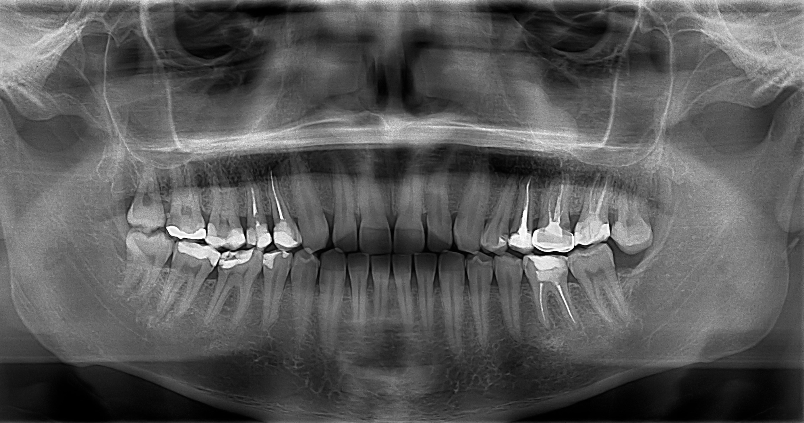Radiografía Panorámica Dental Ortopantomografía Radiología Dental
