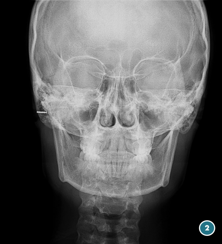 Telerradiografía De Cráneo Lateral O Frontal Radiología Dental Las Palmas 0174